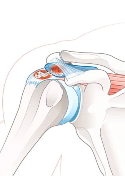 Illustration of calcific tendinitis and bursitis